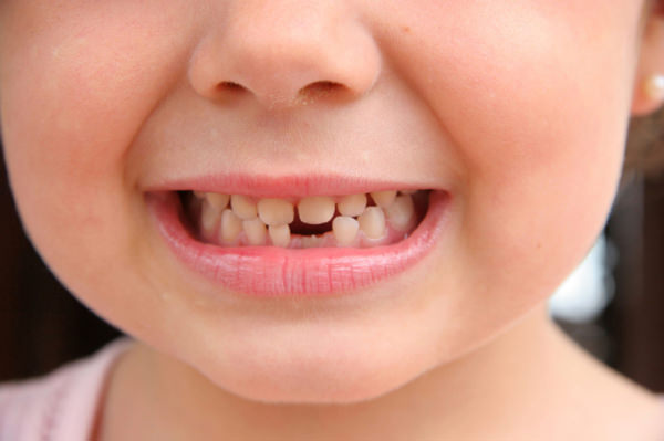 erosao-dentaria-criancas-1